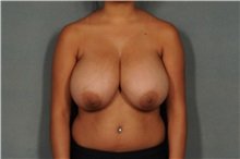 Huge Titties After Reduction Still Look Amazing 4