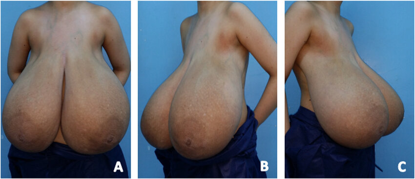 Huge Titties After Reduction Still Look Amazing 7