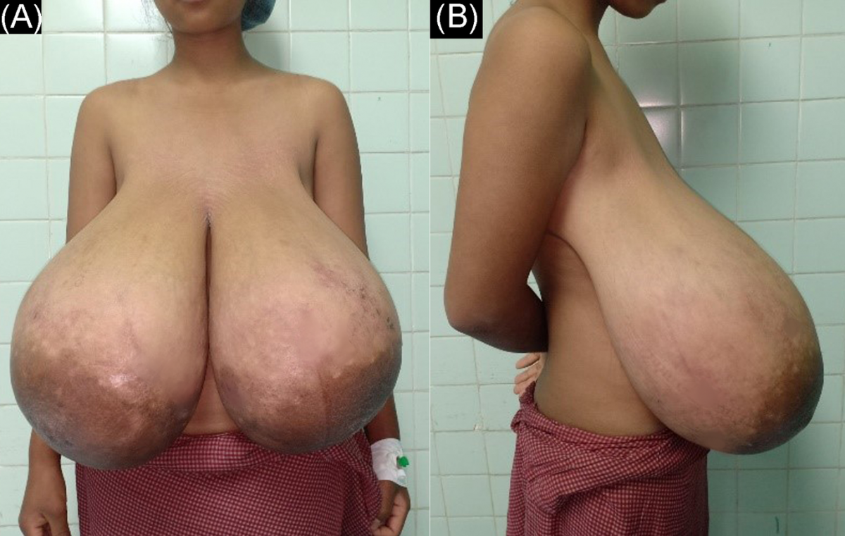 Huge Titties After Reduction Still Look Amazing 20